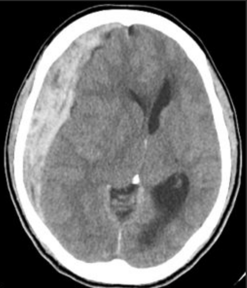 急性硬膜下血腫(Acute Subdural Hematoma)