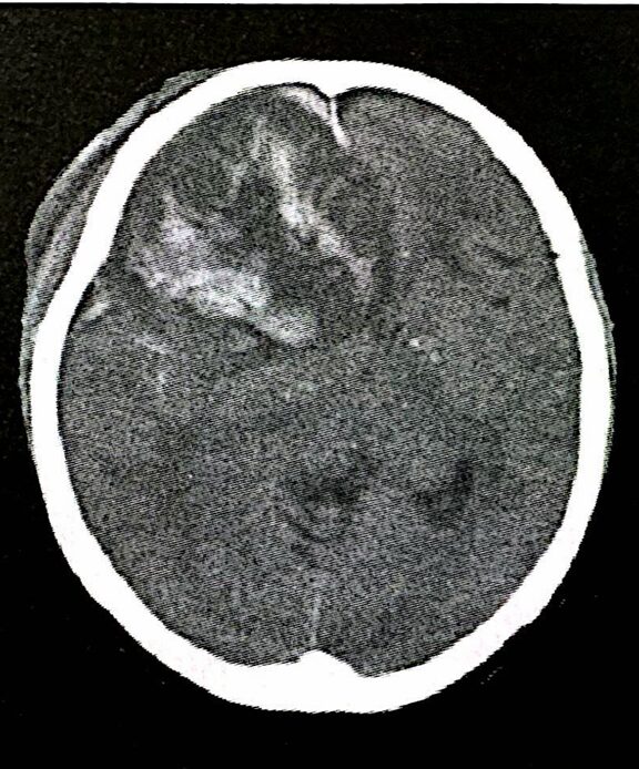 脳挫傷(Brain Contusion)
