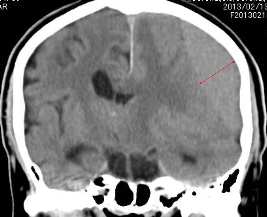 慢性硬膜下血腫
