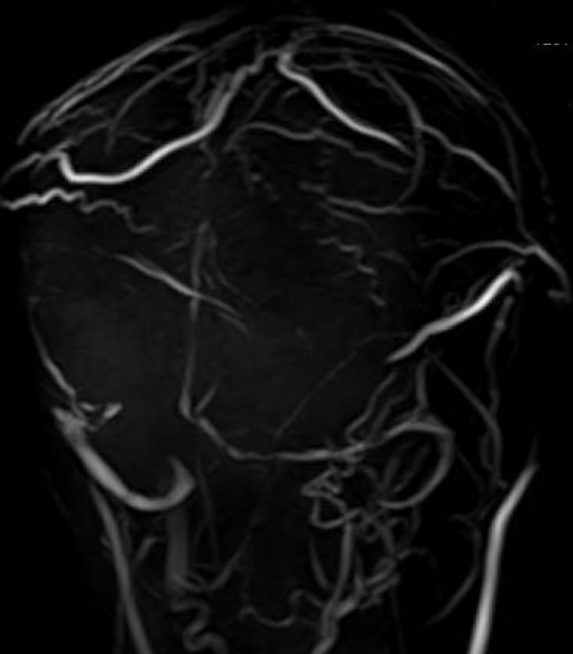 脳静脈洞血栓症