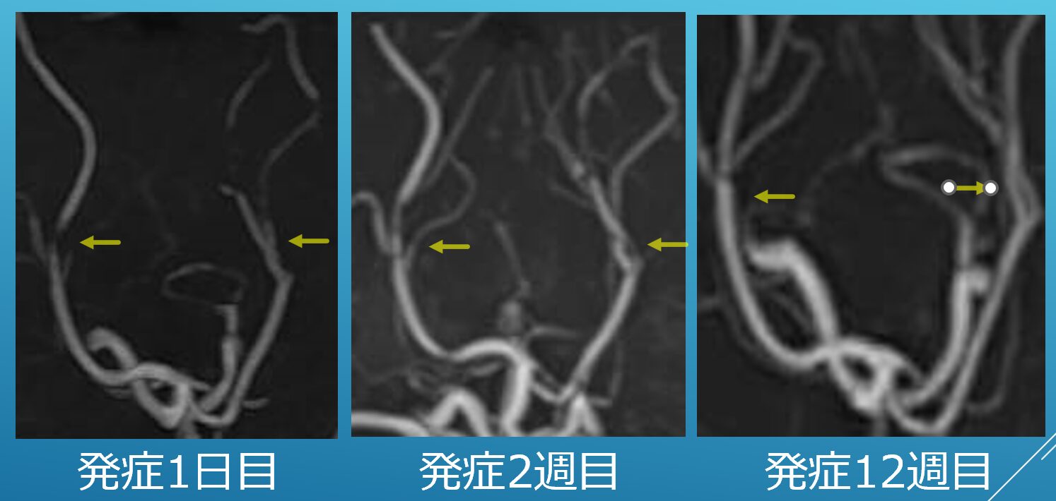 可逆性脳血管攣縮症