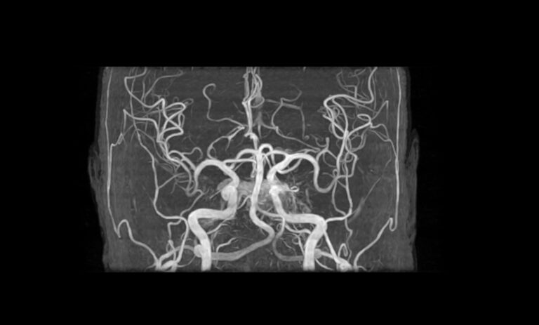 その症状は脳の病気が隠れているかも