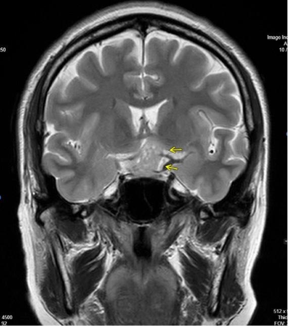 手術加療を要した両耳側半盲で発症した非機能性下垂体腺腫