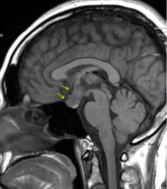 手術加療を要した両耳側半盲で発症した非機能性下垂体腺腫